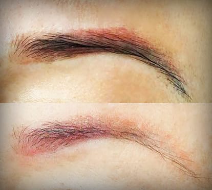 Non laser tattoo removal